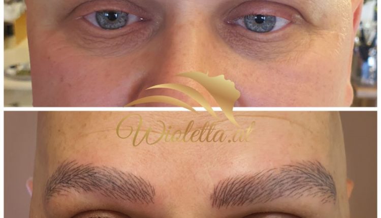 Alopezia 900 1