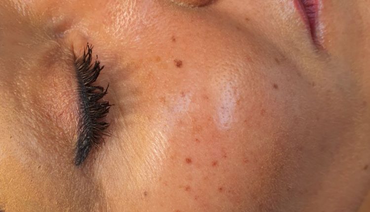 Sommersprossen_Permanent_Make-up_Wien_Wioletta_Dabrowski